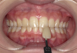 ホワイトニングについての説明、歯の表面クリーニング